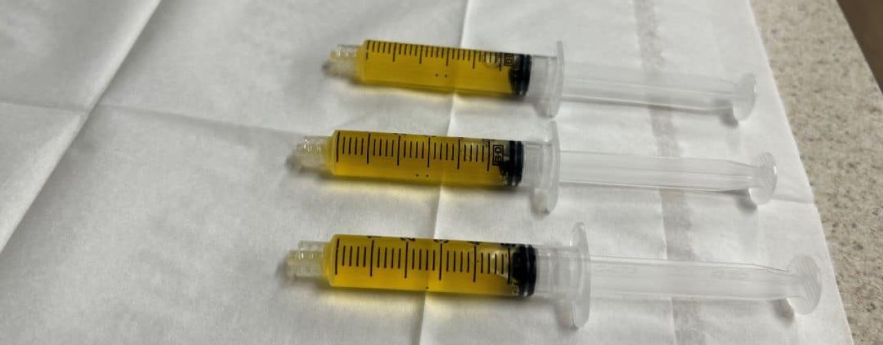 3 PRP syringes, PRP injections side effects